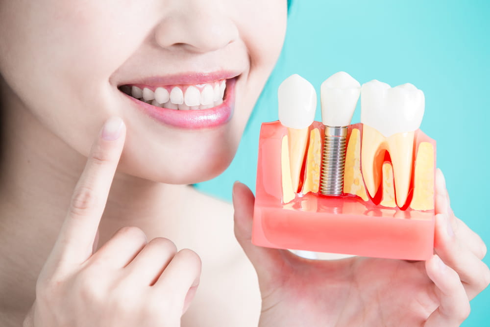 Dantų implantai: gijimo laikotarpis. Ką reikia žinoti?